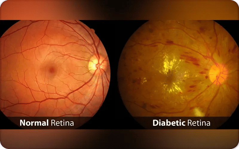 What is Diabetic Retinopathy and How is It Treated?