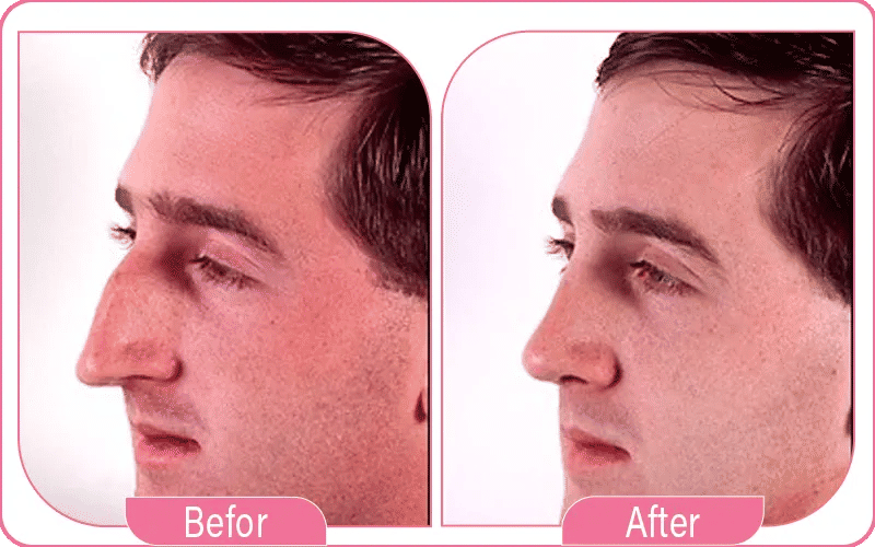 عملية انحراف الوتيرة