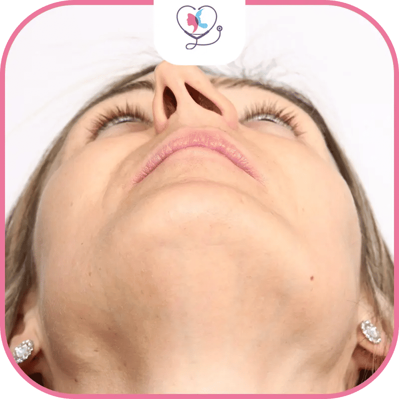 انحراف الحاجز الانفي