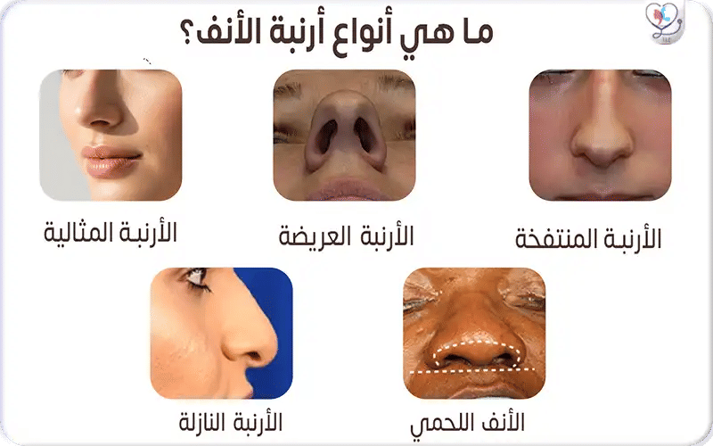 3. الأرنبة المنتفخة أو القُببية (Bulbous Tip)