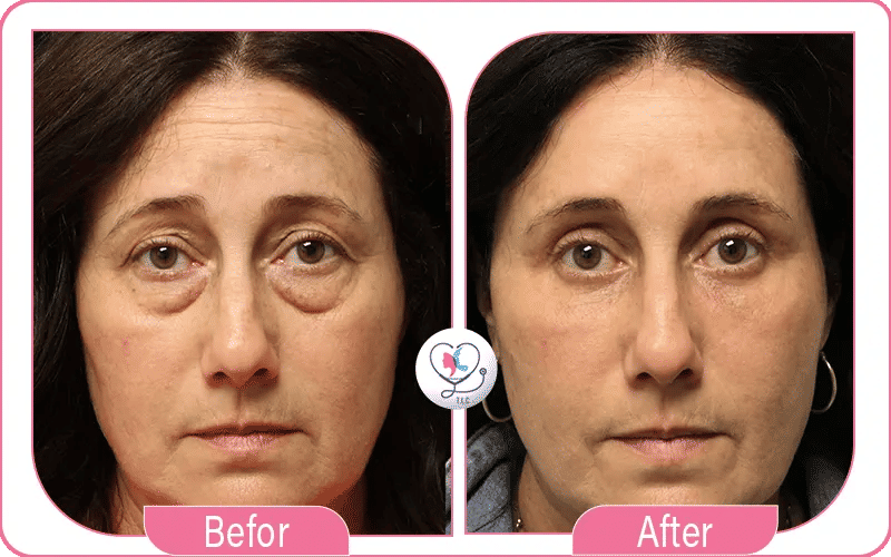 Avis des patients sur la blépharoplastie