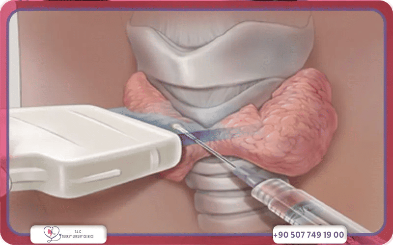 ما هي خزعة الغدة الدرقية؟