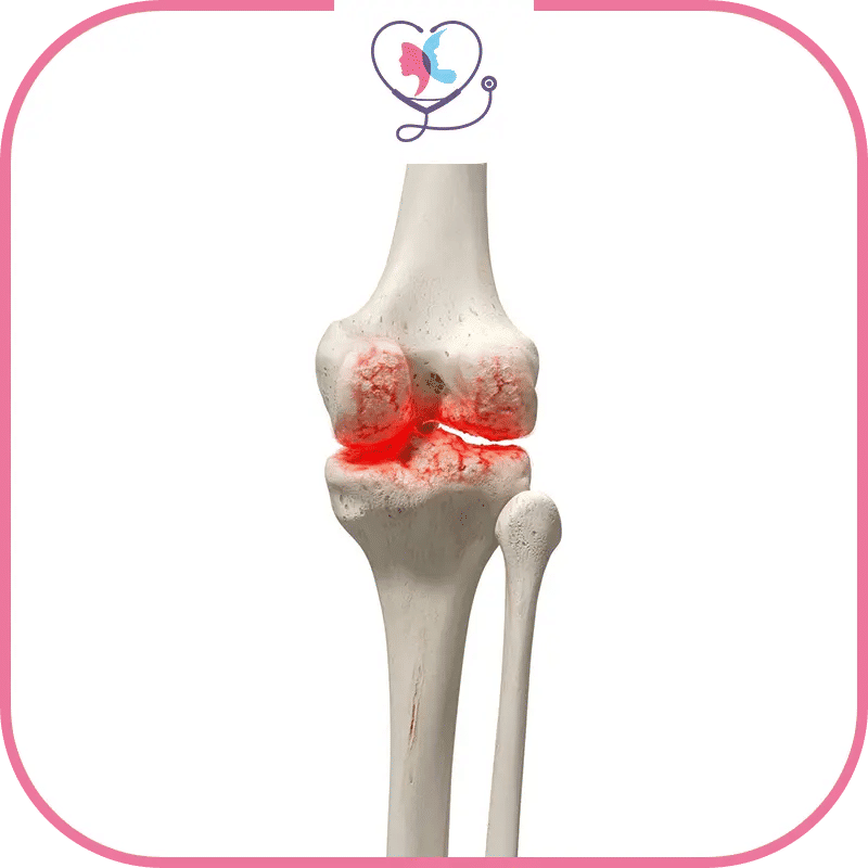 كيف يحدث التهاب مفصل الركبة؟