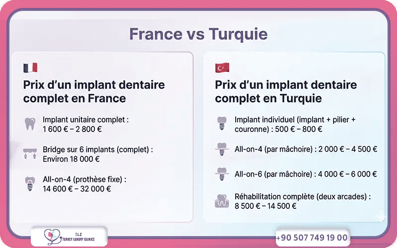 Prix d’un implant dentaire complet en France