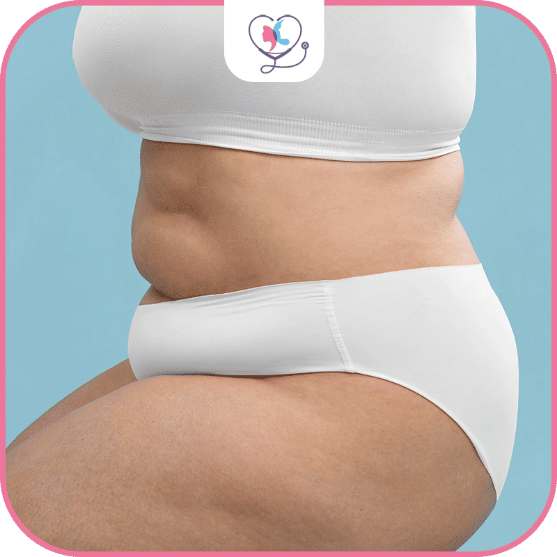 liposuccion douce - liposuccion douce tarif - liposuccion douce prix