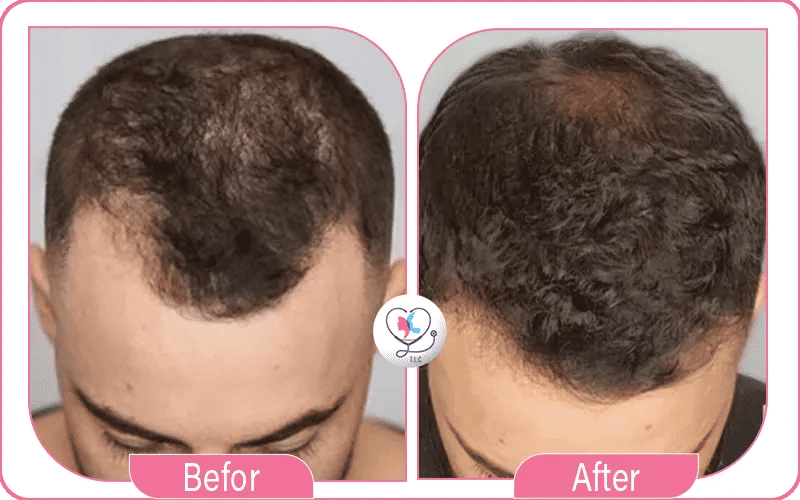 مخاطر الخلايا الجذعية للشعر مخاطر الخلايا الجذعية للشعر