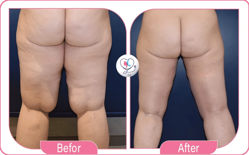 Avis patients sur la liposuccion douce