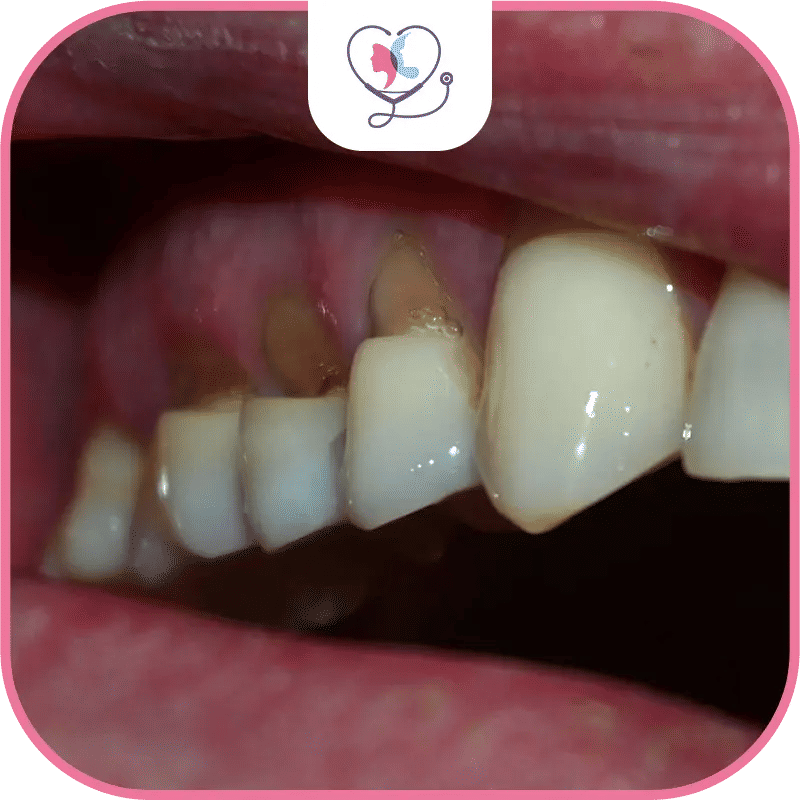 récession gingivale causes