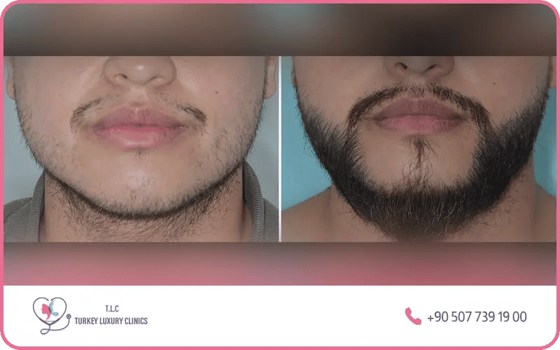 avant et apres du greffe de barbe