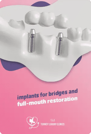 Multiple Teeth Missing? Implants for Bridges and Full-mouth Restorationfeatured image