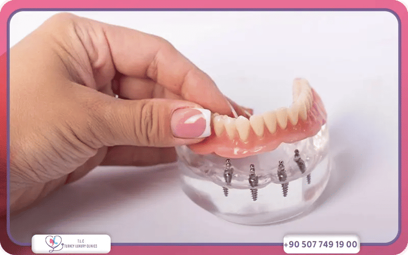 Qu’est‑ce qu’un appareil dentaire clipsé sur implant ?