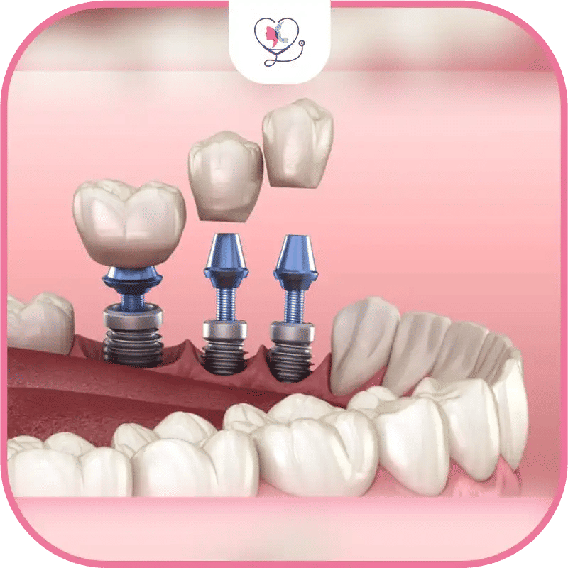 What Are Dental Implants for Multiple Missing Teeth?