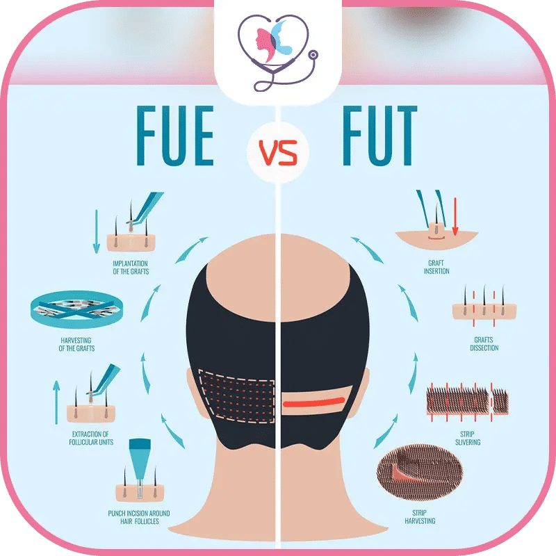 زراعة الشعر في اسطنبول