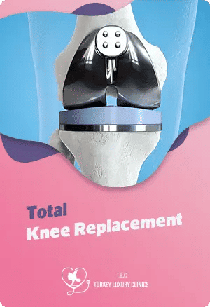 Total Knee Replacement (TKR): the full guide.featured image