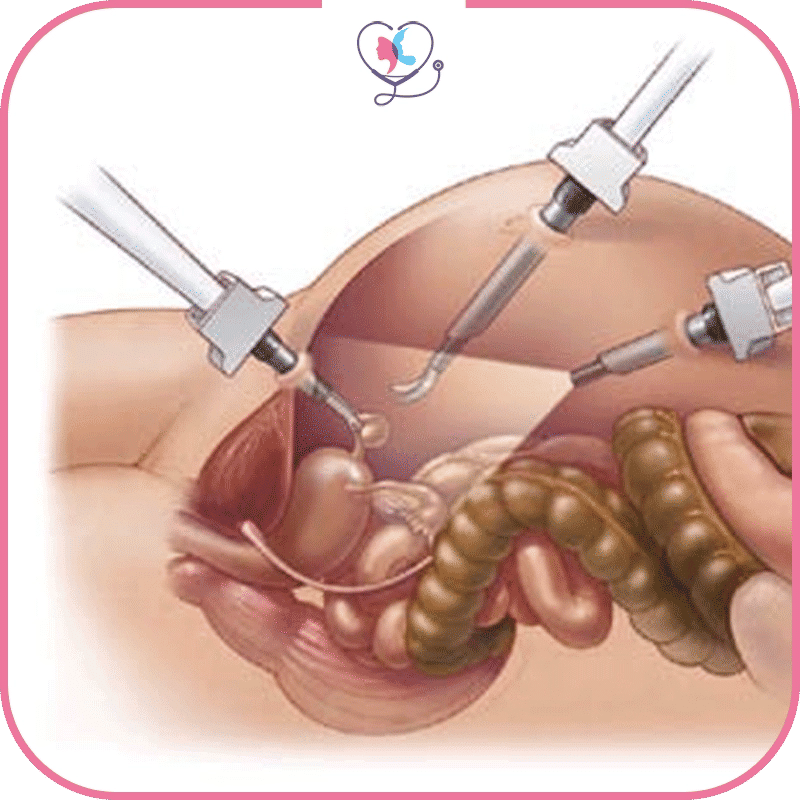 جراحة الأورام بالمنظار