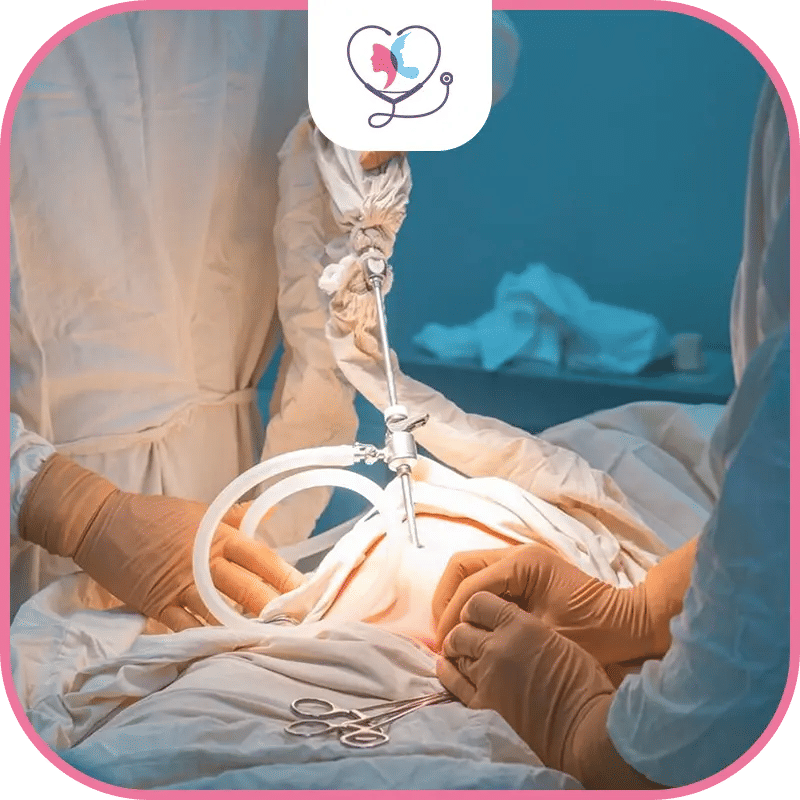 تكميم المعدة بالمنظار في تركيا