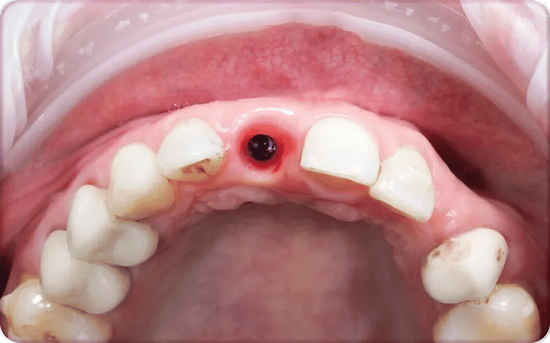 Before and After Bone Loss Bad Dental Implants Pictures