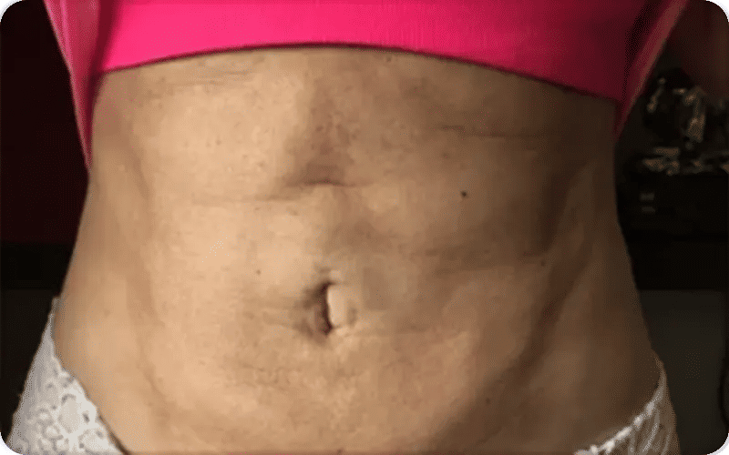 Mistakes That Lead to a Lumpy Stomach After Liposuction