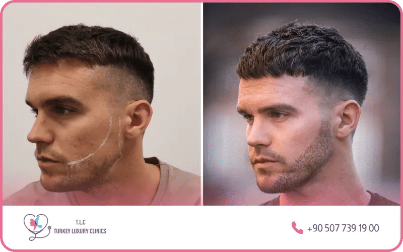 résultats naturels du greffe de barbe