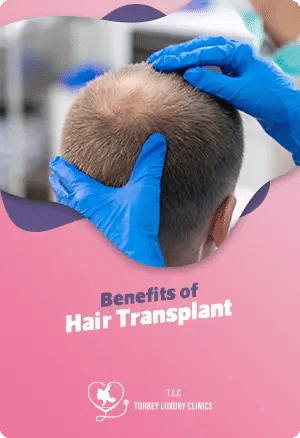 Benefits of Hair Transplantfeatured image