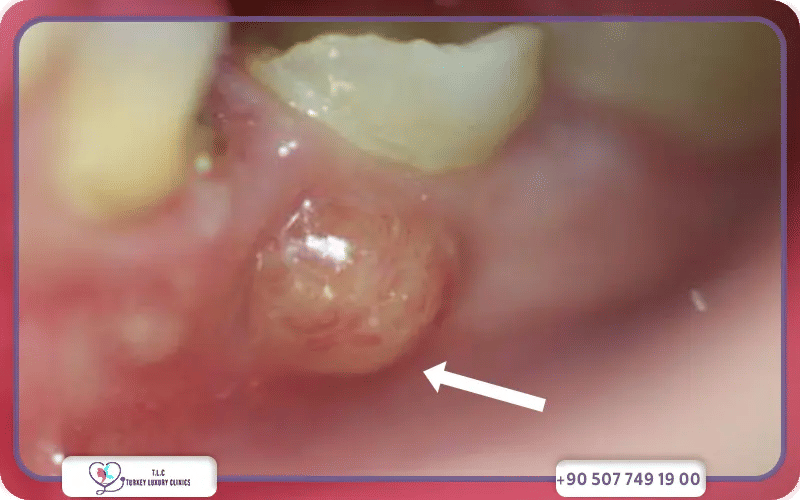 شكل خراج الاسنان-2