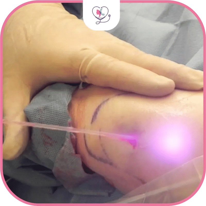 ما هو شفط الدهون بالليزر؟