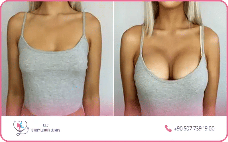 من هنّ المرشحات لإجراء عملية تكبير الثدي مقاس 350؟