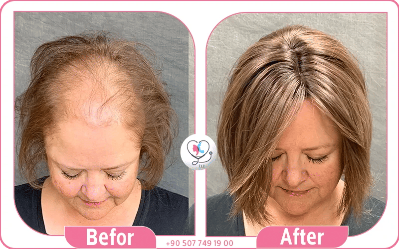 علاج فراغات الشعر للنساء