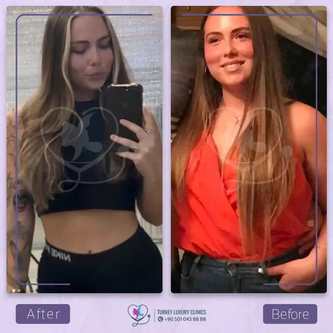 صور قبل وبعد جراحة السمنة في تركيا