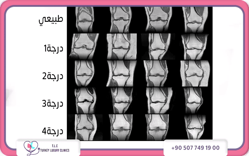 فحص الركبة بالرنين المغناطيسي (MRI) فحص الركبة بالرنين المغناطيسي (MRI)
