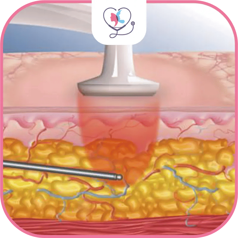 Qu’est-ce que la liposuccion par radiofréquence ?