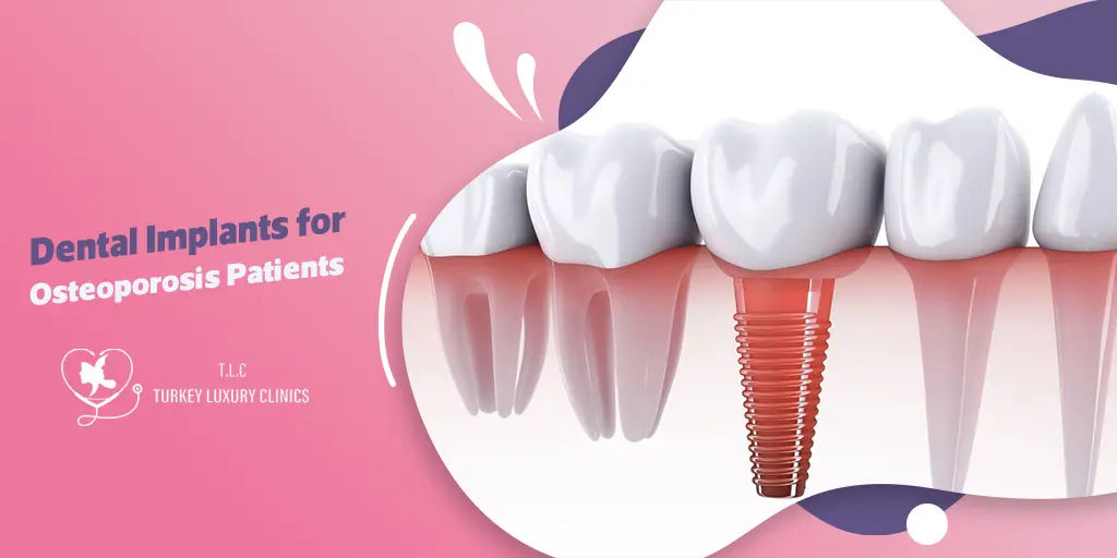 Dental Implants for Osteoporosis Patients