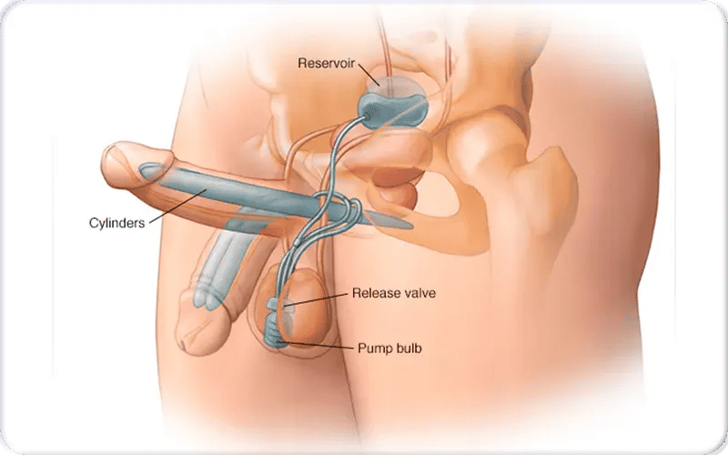 What is a Penile Implant?