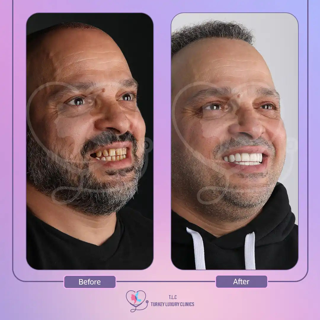 أنواع تركيبات الأسنان لابتسامة هوليود مع تركيا لاكشري كلينك