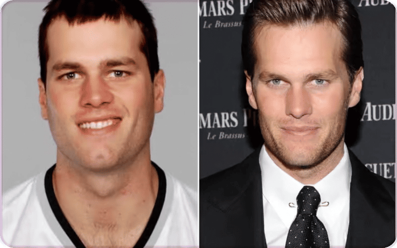 Has Tom Brady Undergone Plastic Surgery?