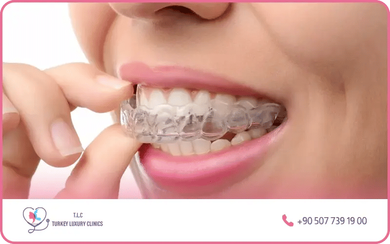 Invisalign Invisalign