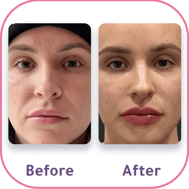 Lip filler before and after results with hyaluronic acid dermal filler