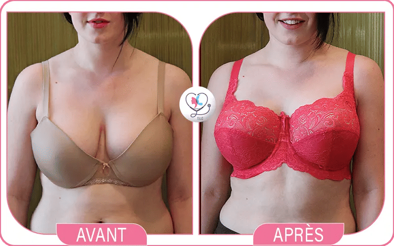 What is Breast Augmentation Surgery?