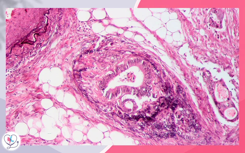 غزو الأوعية الدموية (Vascular Invasion) غزو الأوعية الدموية (Vascular Invasion)