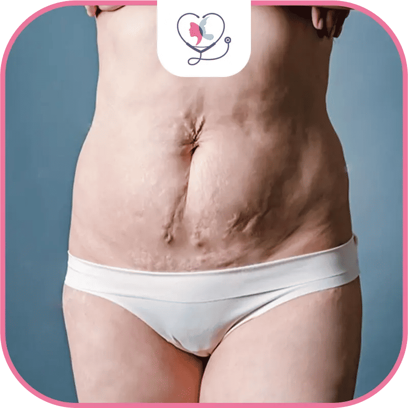 التورم والكدمات بعد شفط الدهون