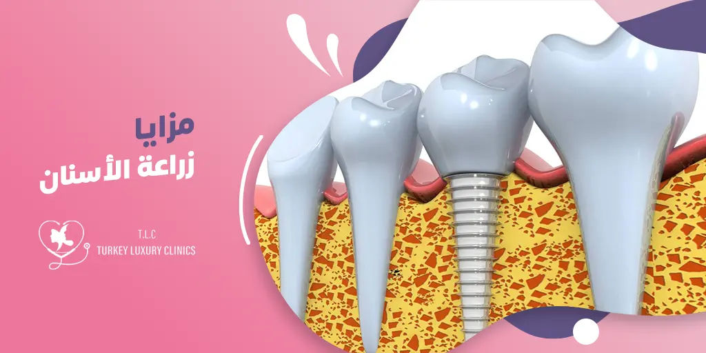 مزايا زراعة الأسنان