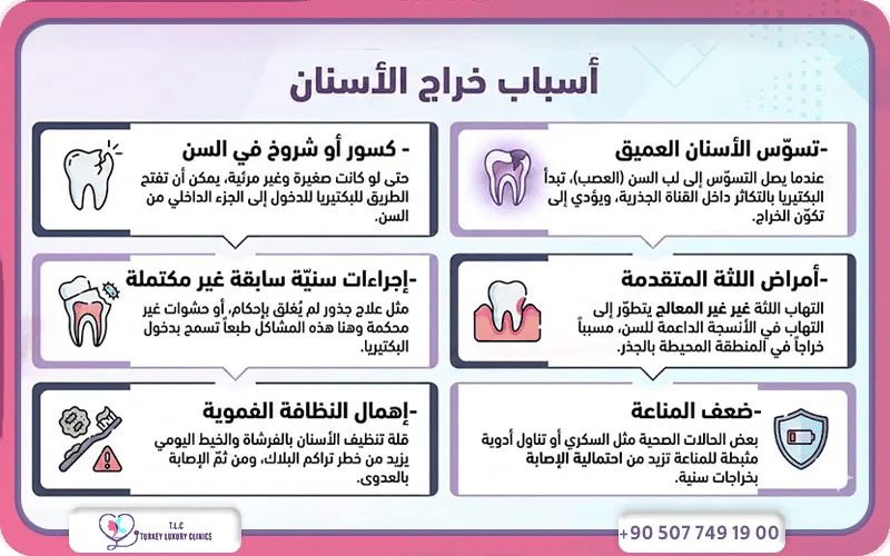 أسباب خراج الأسنان