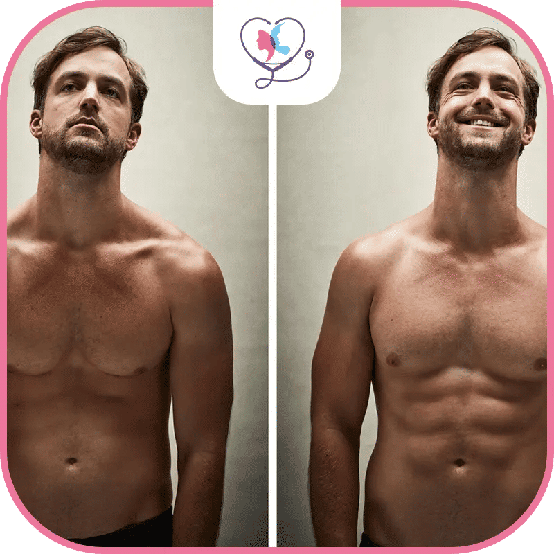 عملية نحت عضلات البطن قبل وبعد