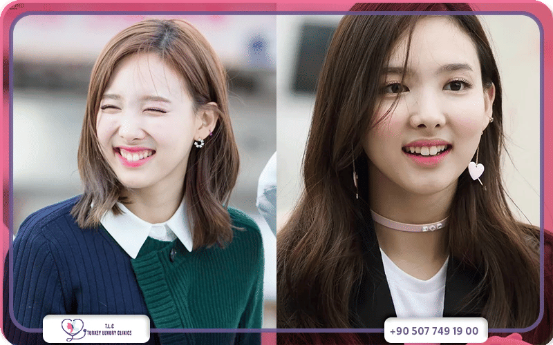 ابتسامة هوليود أسنان الأرنب مع تركيا لاكشري كلينك ابتسامة هوليود أسنان الأرنب مع تركيا لاكشري كلينك