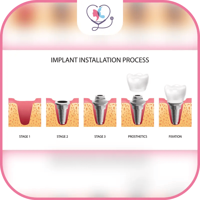 مراحل زراعة الاسنان