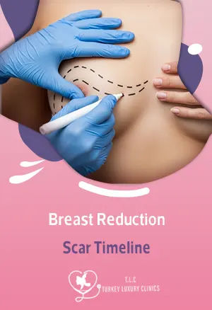 Breast Reduction Scar Timeline: Here's What to Expect