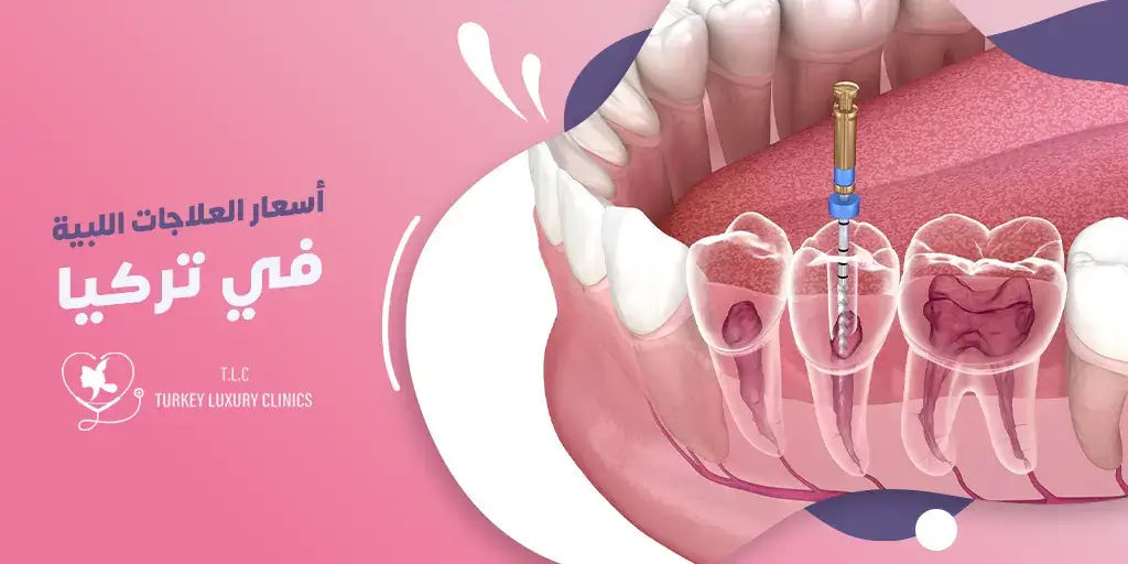 أسعار العلاجات اللبية في تركيا 