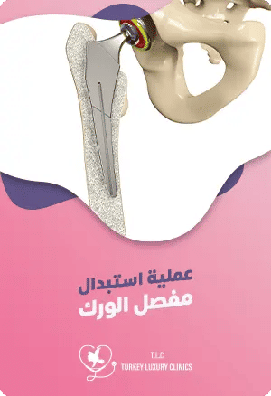 دليل شامل عن عملية تبديل مفصل الورك في تركياfeatured image