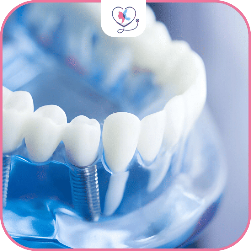 2.-vaste-expérience-en-matière-d'implants-dentaires