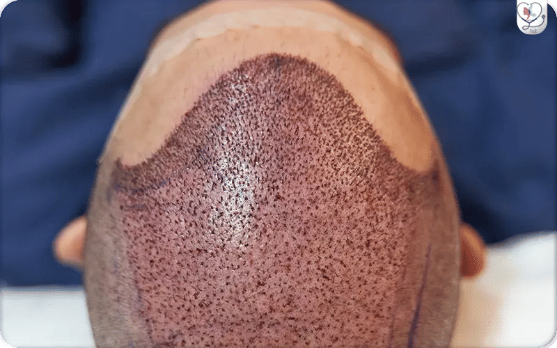 تورم واحمرار تورم واحمرار